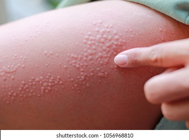 fotos de sarpullidos en niños