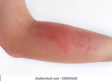 Allergic rash dermatitis eczema skin of patient