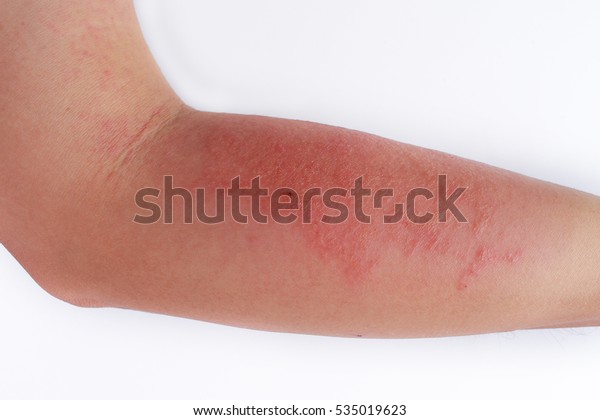 Allergic Rash Dermatitis Eczema Skin Patient Stock Photo Edit Now