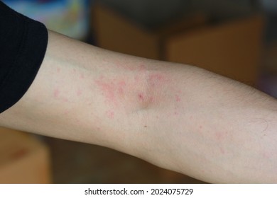 Allergic Rash Hives On Crook Arm Stock Photo 2024075729 | Shutterstock