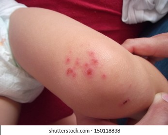 Allergic Rash On The Leg Of A Small Child