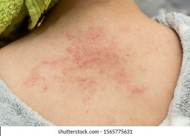 Allergic Rash Of Pimples On The Skin Of A Back