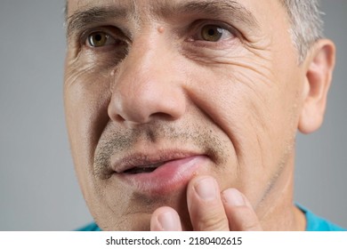 Allergic Reaction To A Bee Sting. An Unshaven Man Was Stung By A Bee And Touches His Face In The Stung Area Close-up. Edema, Swelling Of The Lower Lip