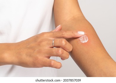 Allergic reaction, itch, allergy, dermatiti concept. Close up of woman applying cream or ointment on swell skin after insect mosquito bites, isolated on grey studio background.  - Shutterstock ID 2037857039