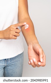 Allergic Reaction, Itch, Allergy, Dermatiti Concept. Close Up Of Woman Applying Cream Or Ointment On Swell Reddened Skin After Insect Mosquito Bites, Isolated On Grey Studio Background. 