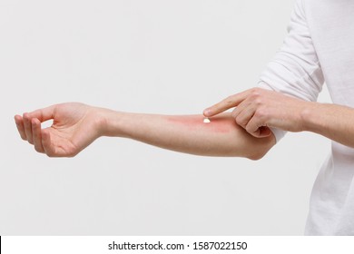 Allergic Reaction, Itch, Dermatitis, Dry Skin. Man Is Applying Cream/ointment On The Swell Skin Against Mosquito Bites, Isolated On White Background, Close Up. 