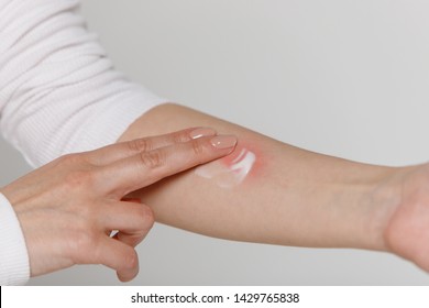 Allergic Reaction, Itch, Dermatitis. Woman Is Applying Cream/ointment On The Swell Skin Against Mosquito Bites, Isolated On Grey Background, Close Up. 