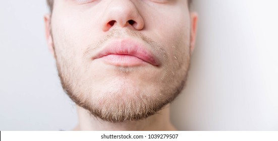 Allergic Reaction In Men. Angioedema.