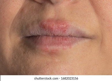 Hives on lips allergic reaction