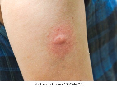 Allergic reaction to insect bites crossword