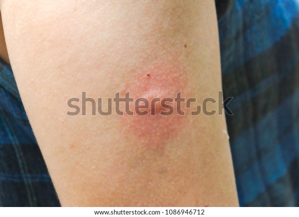 Foto Stok Allergic Reaction Mosquito Bites Edit Sekarang 1086946712