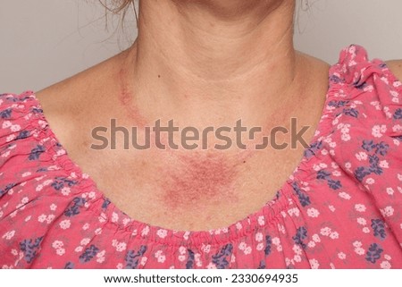 Allergic reaction on a woman's neck. Widespread redness on the skin of a lady wearing metal necklaces. Concept of erythema for allergy to nickel or chromium of costume jewellery Foto stock © 