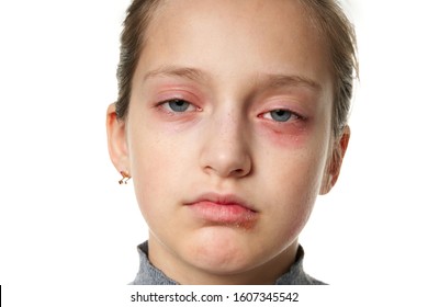 Allergic reaction, skin rash, close view portrait of a girl's face. Redness and inflammation of the skin in the eyes and lips. Immune system disease. - Shutterstock ID 1607345542