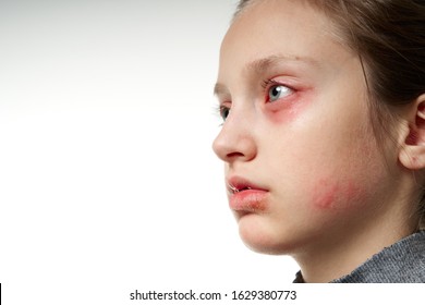 Allergische Reaktion Bilder Stockfotos Und Vektorgrafiken Shutterstock