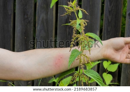 Allergic reaction to urtica or nettle grass. Red spot and blisters on a man's hand from a stinging nettle burn. Selective focus, blurred foreground