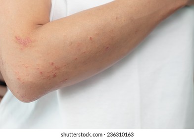 Allergic Skin Lesions On The Arms Thailand Asian Women.