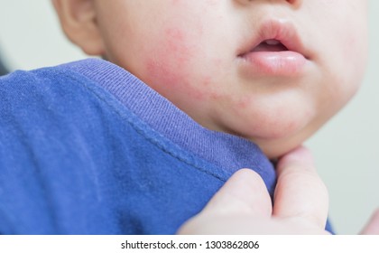 Allergic Skin Of Patient Baby, Dry Skin On Cheek Of Baby