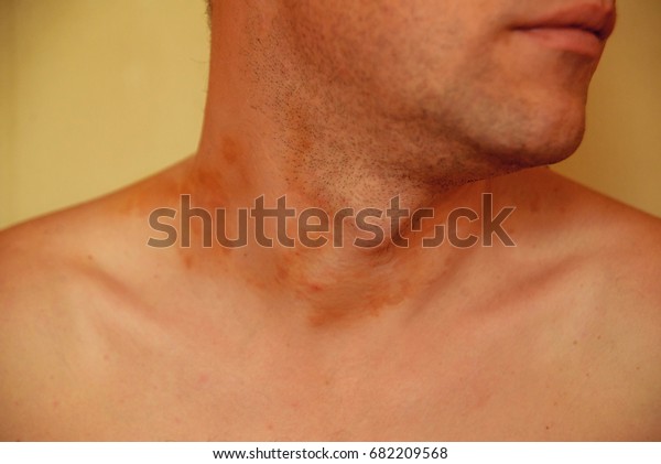 Allergic Skin Rash Spots On Neck Stock Photo Edit Now 682209568
