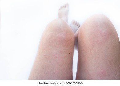Allergic skin rash, swelling, itching. Skin allergy urticaria