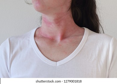 Allergic Skin Reaction On The Female Neck And Face