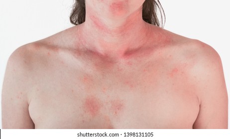 Allergische Hautreaktionen an Hals und Gesicht - roter Ausschlag