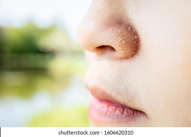 Allergic Young Woman Have Eczema Dry Nose On Winter Season,female People Peeling Skin With Seborrheic Dermatitis,atopic Dermatitis Symptom On Her Nose,flaky Skin On The Face Or Allergic Reaction 