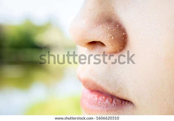 Allergic young woman have eczema dry nose on winter\
season,female people peeling skin with seborrheic dermatitis,atopic\
dermatitis symptom on her nose,flaky skin on the face or allergic\
reaction 