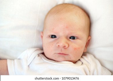 Allergies, Atopic Dermatitis On The Face Of A Baby