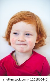 Allergies, Atopy, Atopic Dermatitis, Dermatitis, Ecdysis Boy, Red-haired, Blue-eyed, Boy, Male, European, Curly