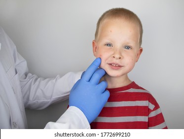 An Allergist Or Dermatologist Examines Red Spots On A Child’s Face. The Boy Suffers From A Rash, Hives And Itching. Food Allergy, Insect Bite, Measles Or Chicken Pox