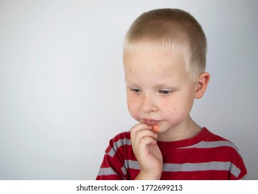 An Allergist Or Dermatologist Examines Red Spots On A Child’s Face. The Boy Suffers From A Rash, Hives And Itching. Food Allergy, Insect Bite, Measles Or Chicken Pox