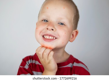 An Allergist Or Dermatologist Examines Red Spots On A Child’s Face. The Boy Suffers From A Rash, Hives And Itching. Food Allergy, Insect Bite, Measles Or Chicken Pox