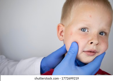 An Allergist Or Dermatologist Examines Red Spots On A Child’s Face. The Boy Suffers From A Rash, Hives And Itching. Food Allergy, Insect Bite, Measles Or Chicken Pox