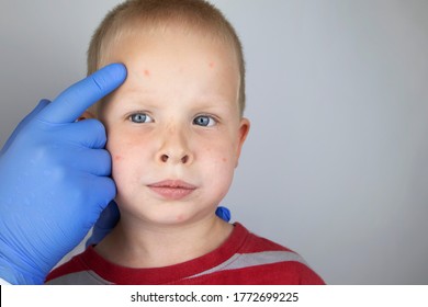 An Allergist Or Dermatologist Examines Red Spots On A Child’s Face. The Boy Suffers From A Rash, Hives And Itching. Food Allergy, Insect Bite, Measles Or Chicken Pox