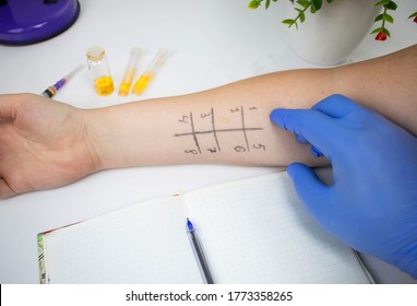 An Allergist Doctor In The Laboratory Conducts A Prik Allergy Test. Skin Test For Household, Food, Epidermal Allergic Reactions