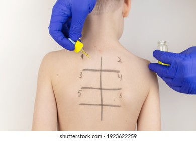 An Allergist In The Laboratory Conducts An Allergy Prick-test. Skin Test For Household, Food, Epidermal Allergic Reactions. The Test Is Performed On The Patient's Back. Child At A Doctor's Appointment