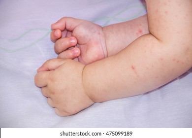 Allergy Baby Skin Dermatitis Food. Child Dermatitis Symptom Problem Rash. Face Sleeping Newborns.  Suffering Atopic Symptom On Skin Cheeks. Concept Child Health. Allergic Reaction To The Medication