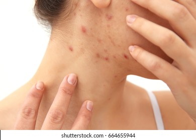 Allergy concept. Young woman with pimples on her face, closeup