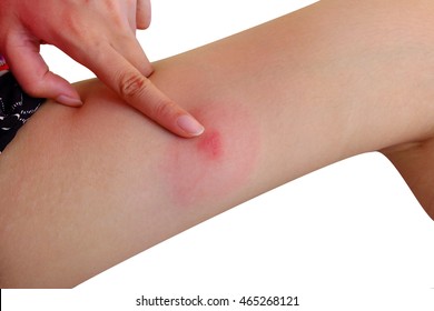 Allergy Mosquito Bites Leg  Itching   Red Spot Lag  Isolated White Background