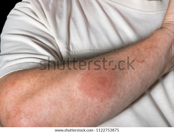 Foto Stok Allergy Mosquito Bites Allergy Unrecognizable Insect Edit Sekarang 1122753875