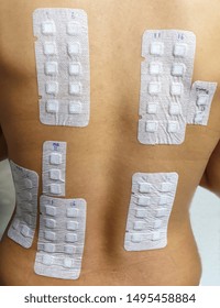 Allergy Patch Test on Back of Female Patient done by Dermatological in the skin department of a hospital