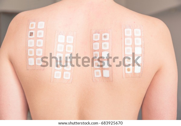 Allergy Patch Test On Back Female Stock Photo (Edit Now) 683925670