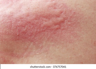 allergy rash of human. dermatitis problem. skin problem. - Shutterstock ID 376757041