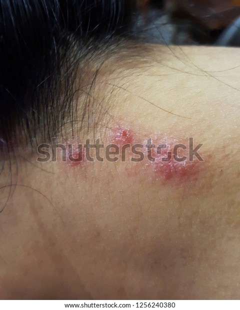 Allergy Red Rash On Neck Skin People Stock Image