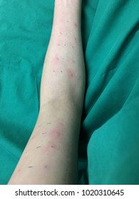 Allergy Skin Prick Testing.