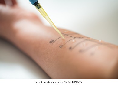 Allergy - Skin Prick Tests on a Woman’s Arm