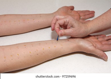 Allergy Skin Test