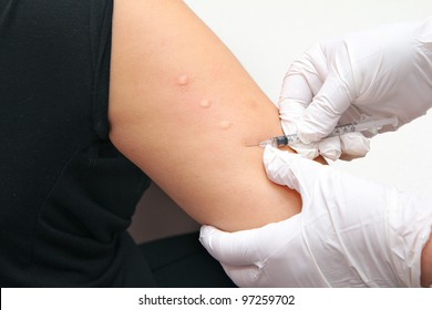 Allergy Skin Test