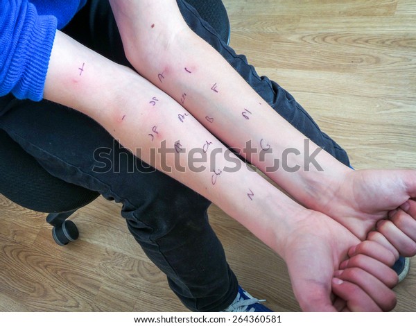 Allergy skin test on the\
arms of a boy