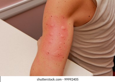 Allergy Skin Testing